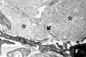 M,60y. | jejunum - amyloidosis